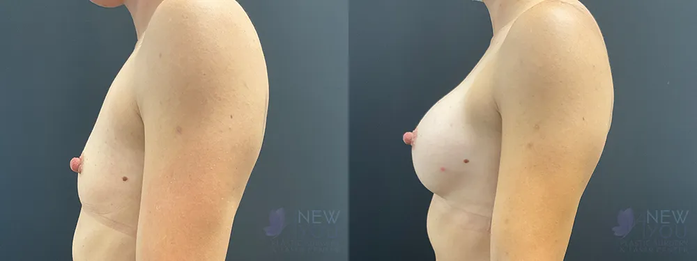 breast-augmentation-93a-ba3