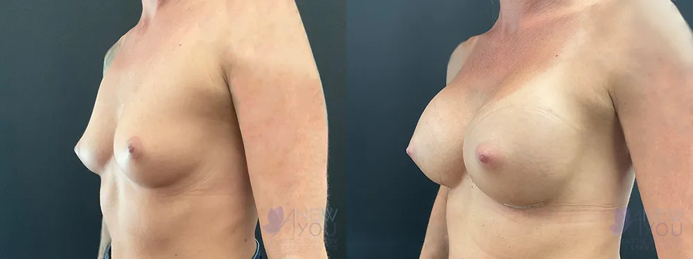 breast-augmentation-94a-ba2