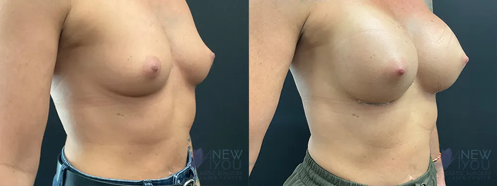 breast-augmentation-94a-ba3