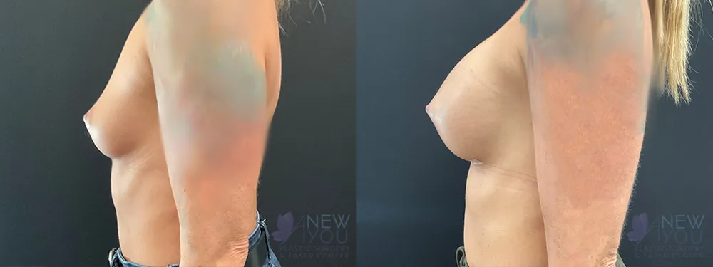 breast-augmentation-94a-ba4