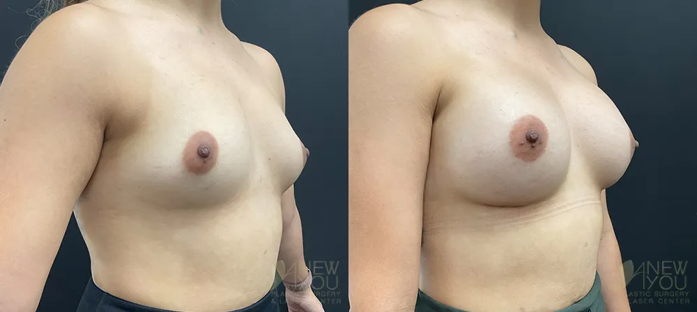 breast-augmentation-96a-ba2