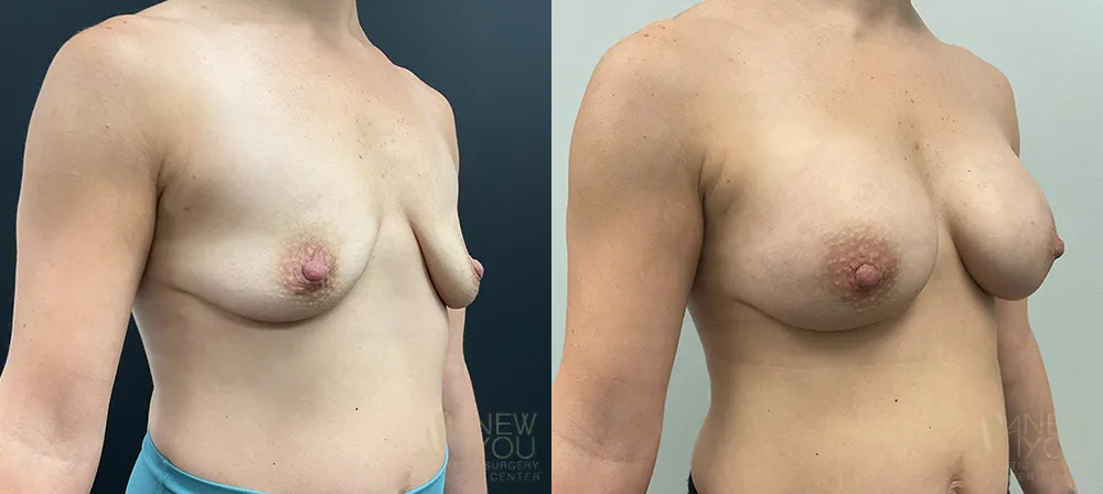 breast-augmentation-97a-ba2