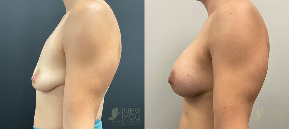 breast-augmentation-97a-ba3
