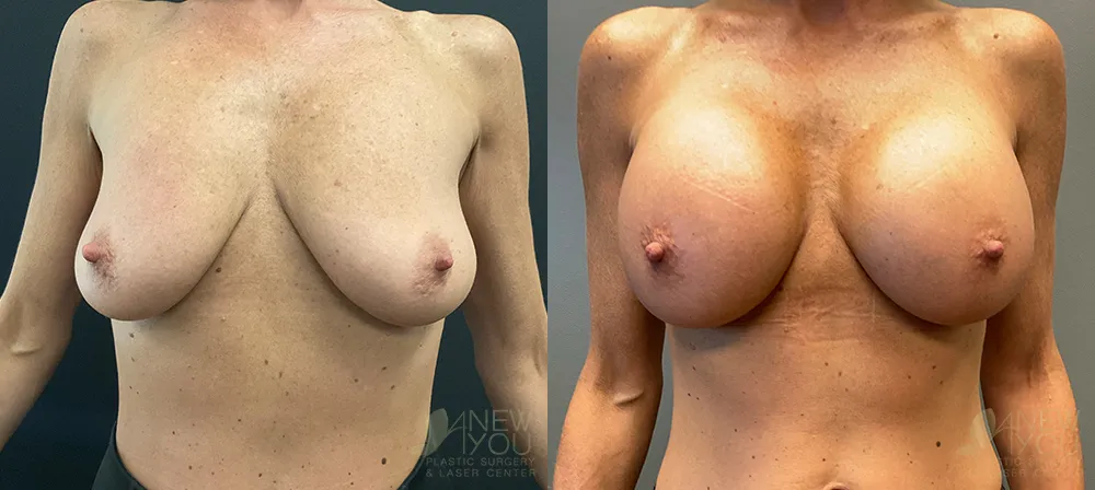 breast-augmentation-98a-ba1