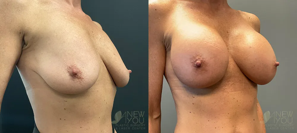breast-augmentation-98a-ba2