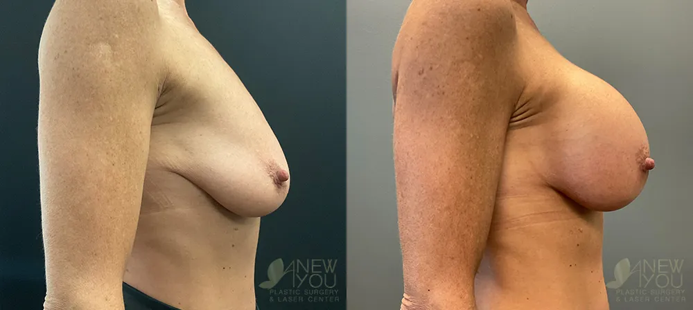 breast-augmentation-98a-ba3