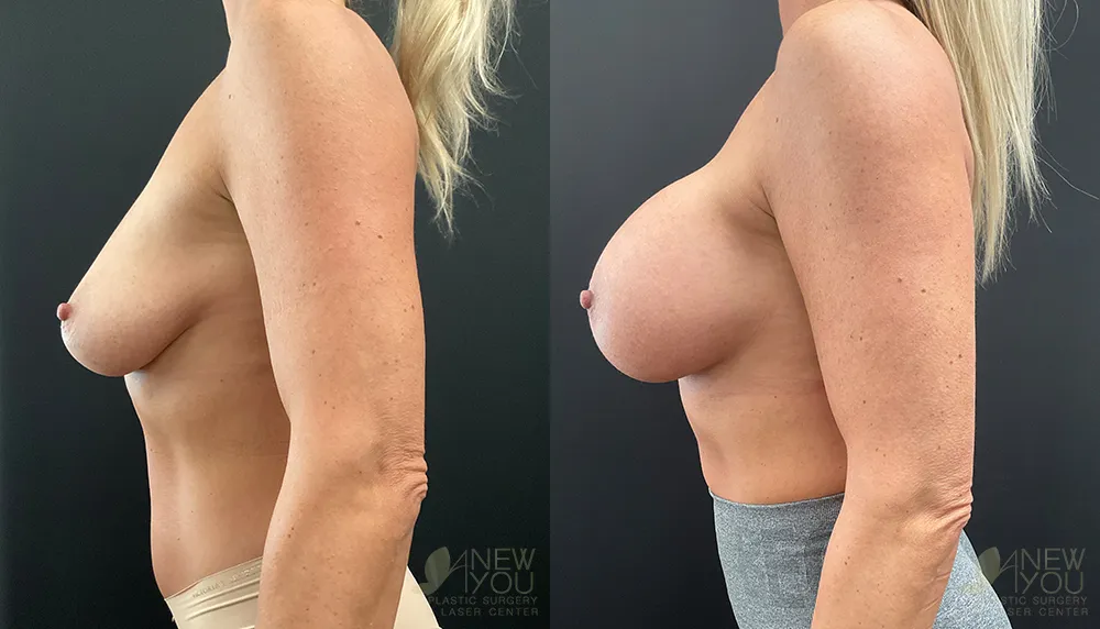 breast-augmentation-99a-ba3