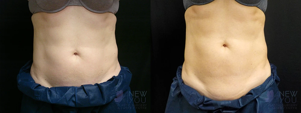 coolsculpting-1