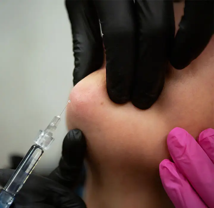 dermal filler- recovery