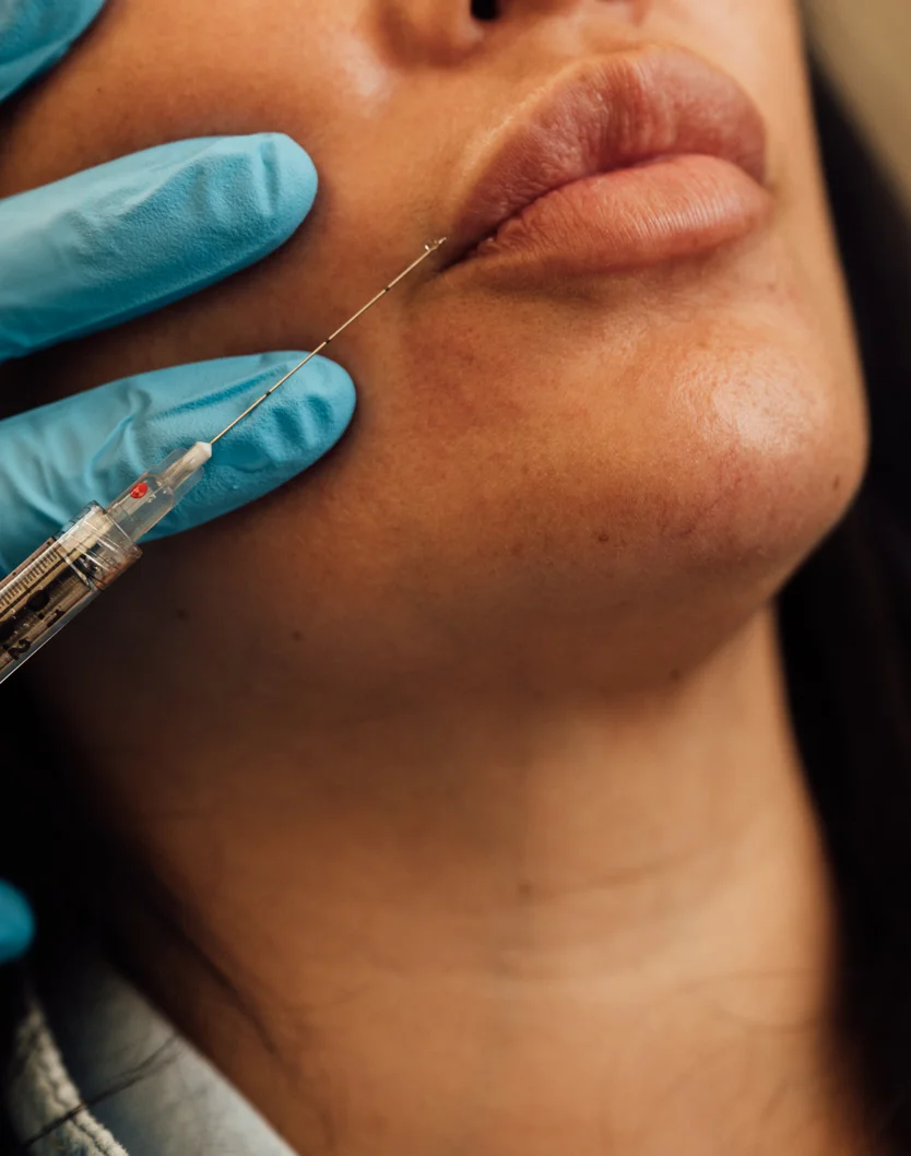 lip-fillers-intro-v2