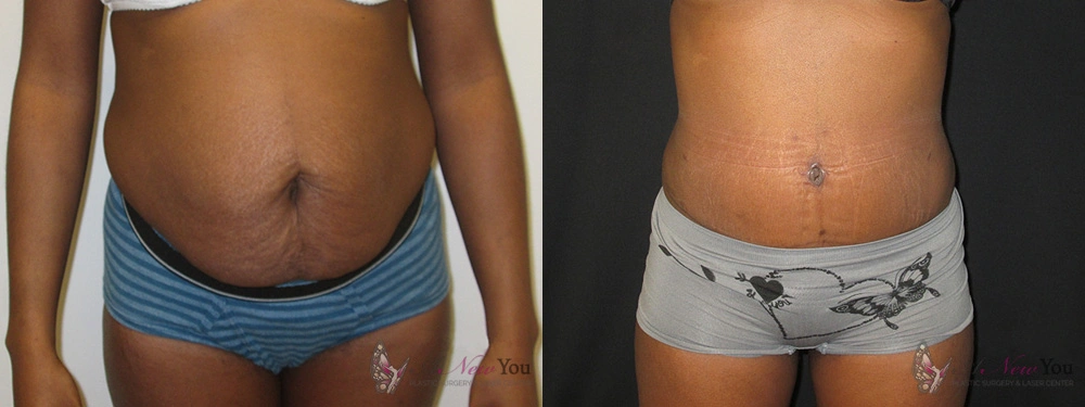 tummy-tuck-03a-before