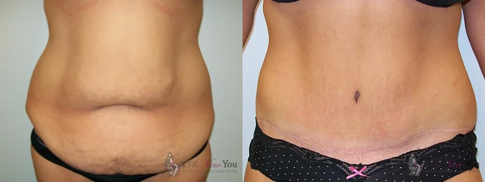 tummy-tuck-1