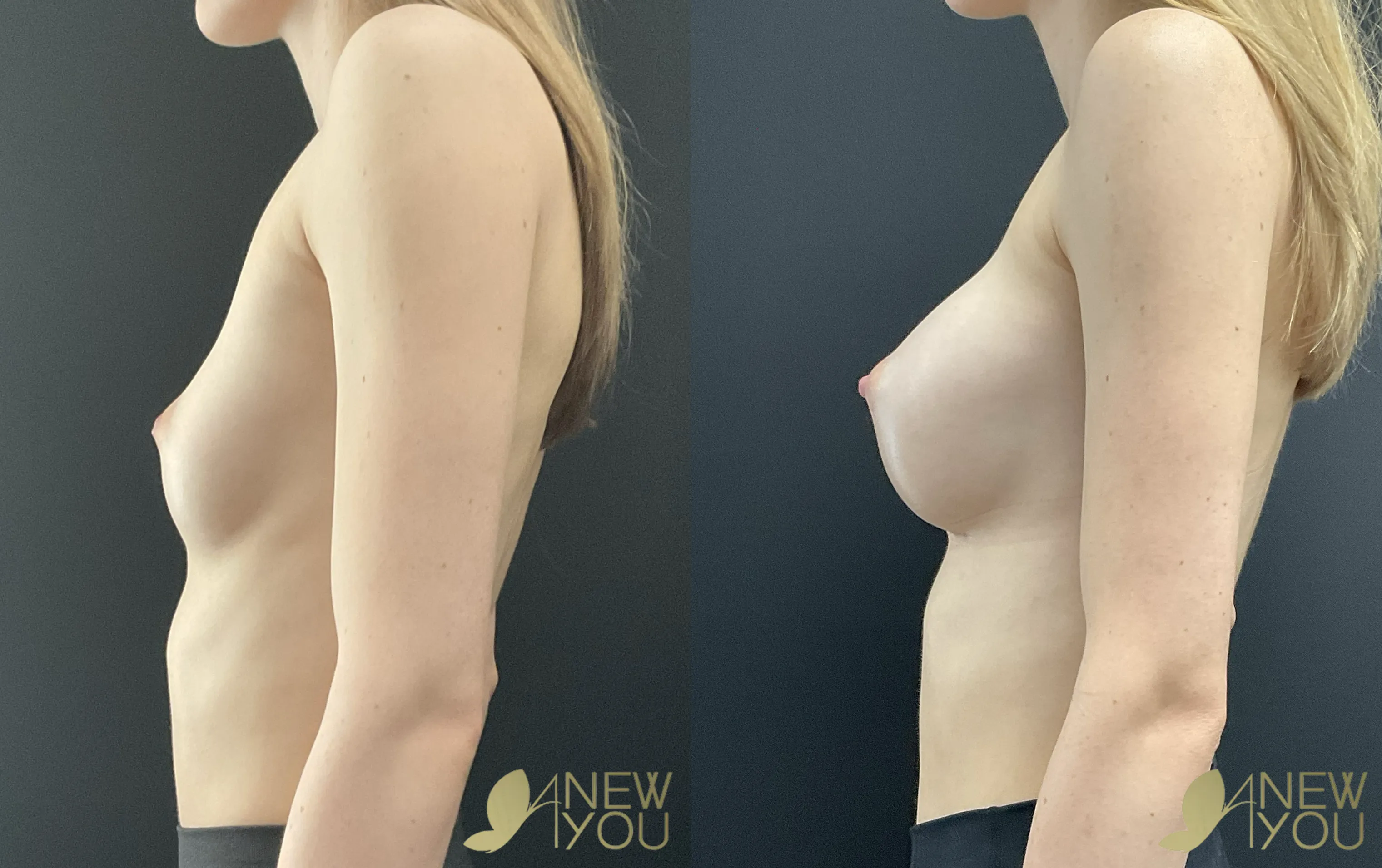 breast-aug-gg-left-side