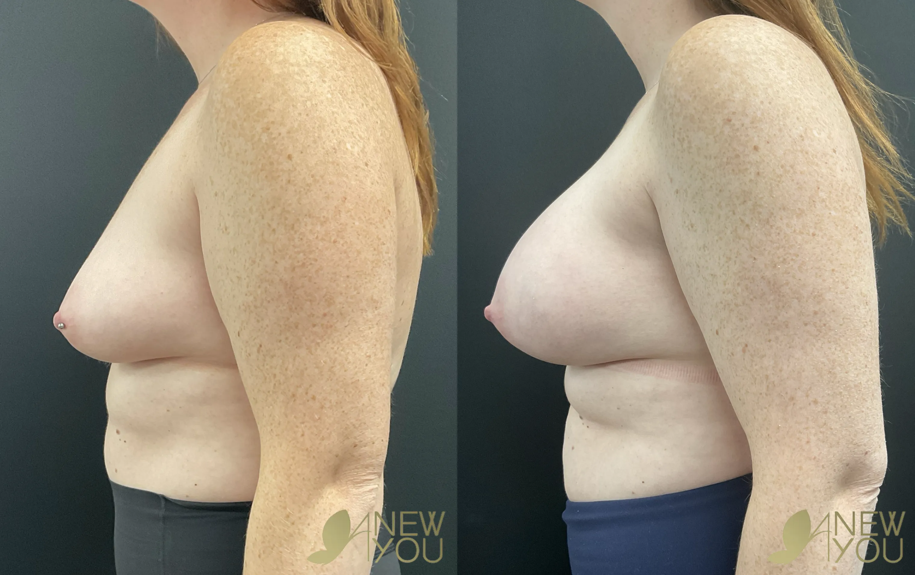 breast-aug-rk-left-side