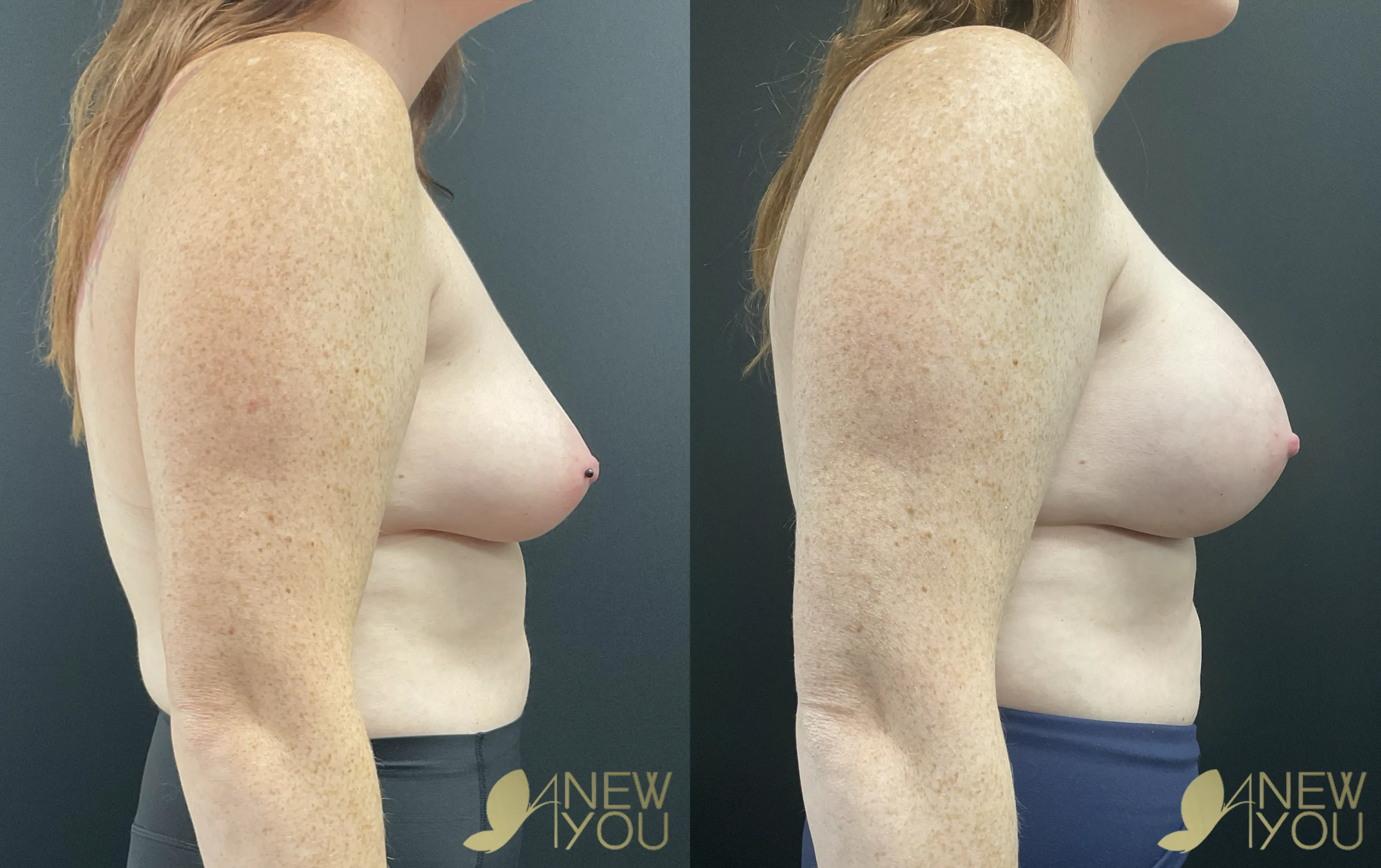 breast-aug-rk-right-side