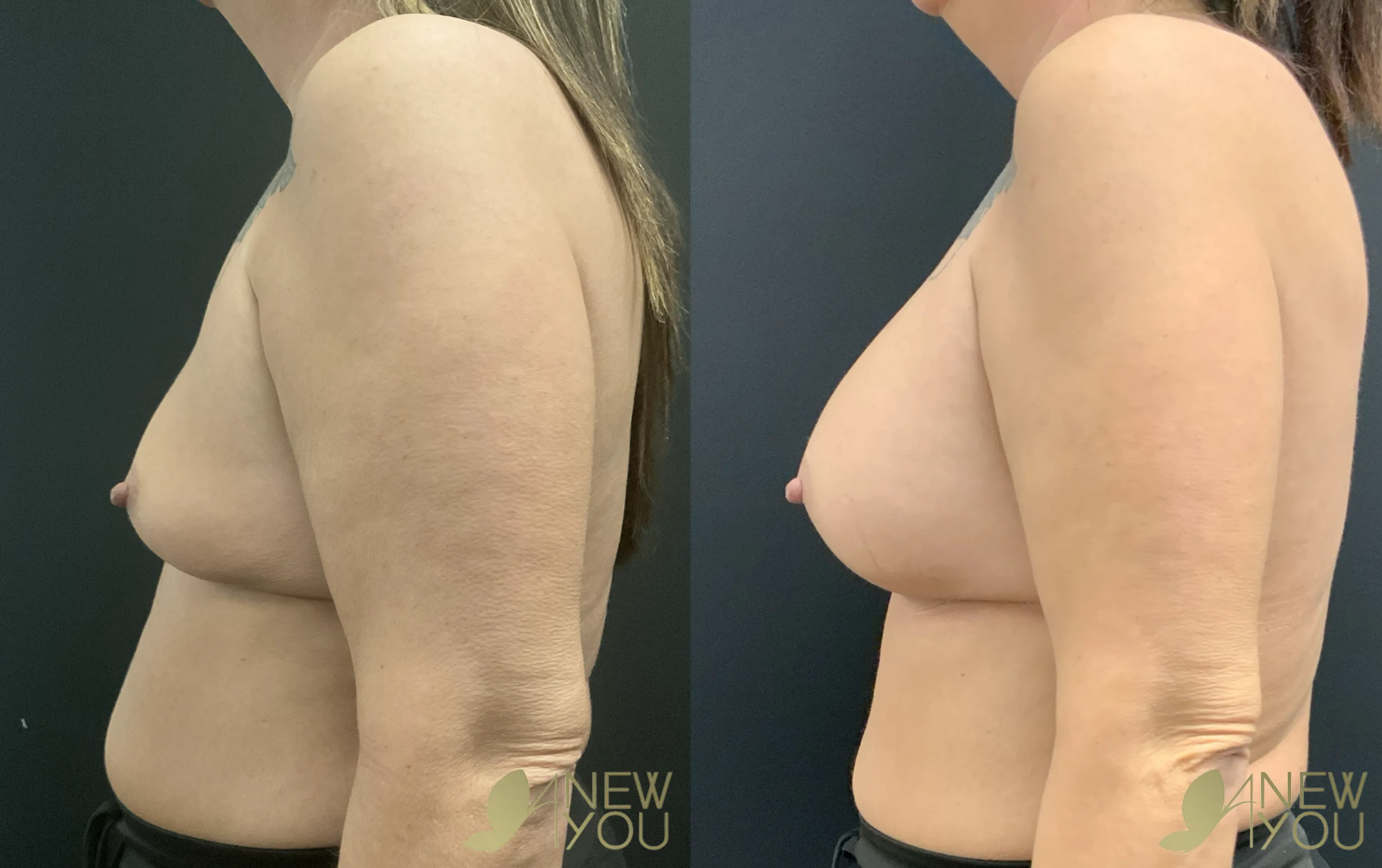 breast-aug-tt-left-side