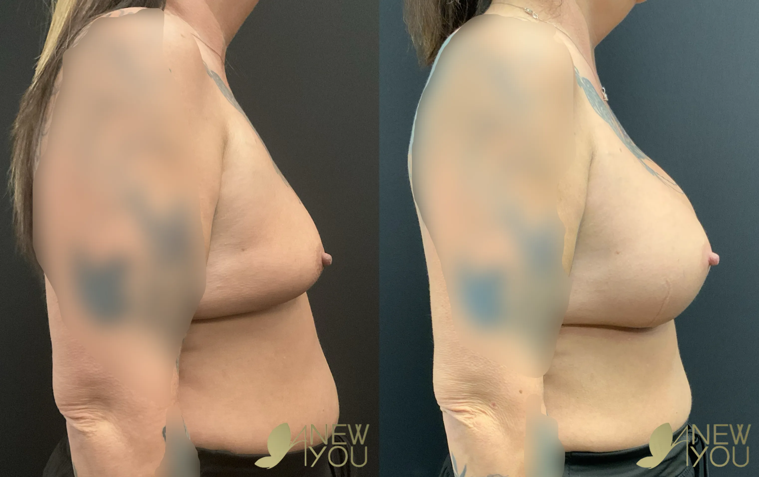 breast-aug-tt-right-side