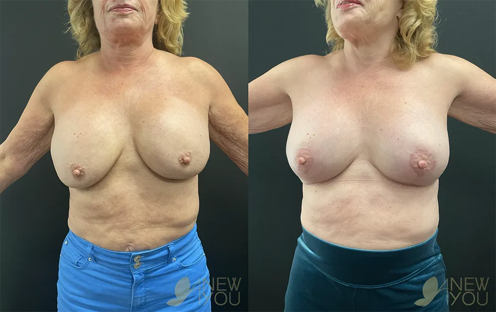 breat-rev-tt-front-side-