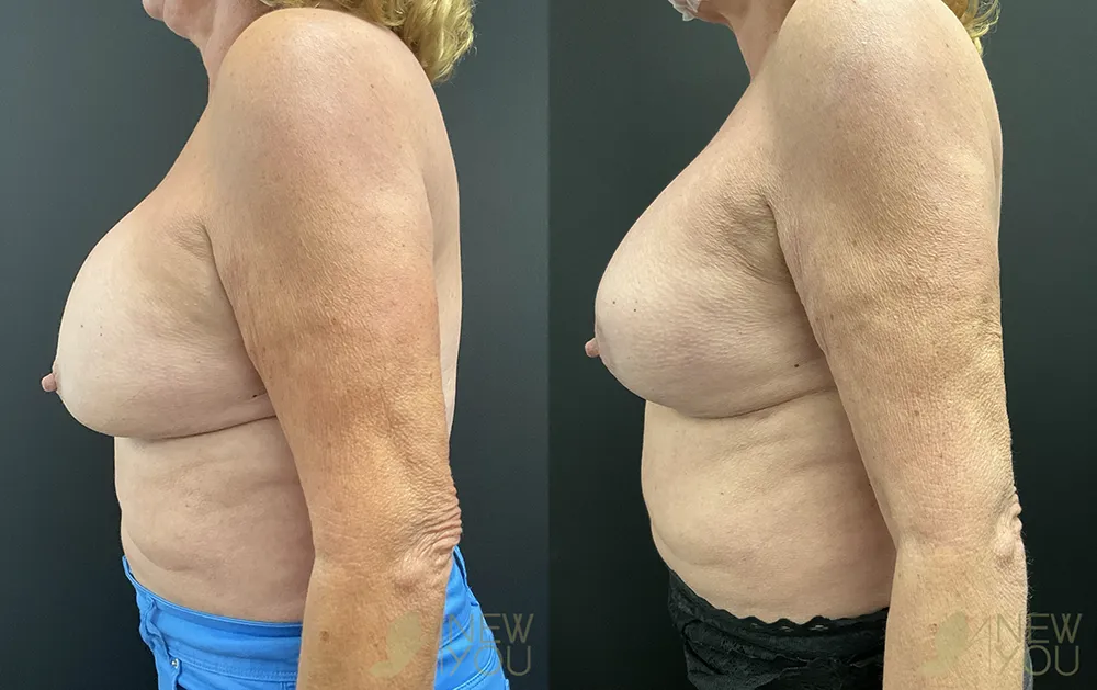 breat-rev-tt-left-side-