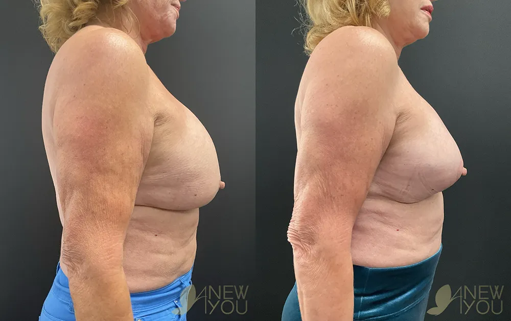 breat-rev-tt-right-side-