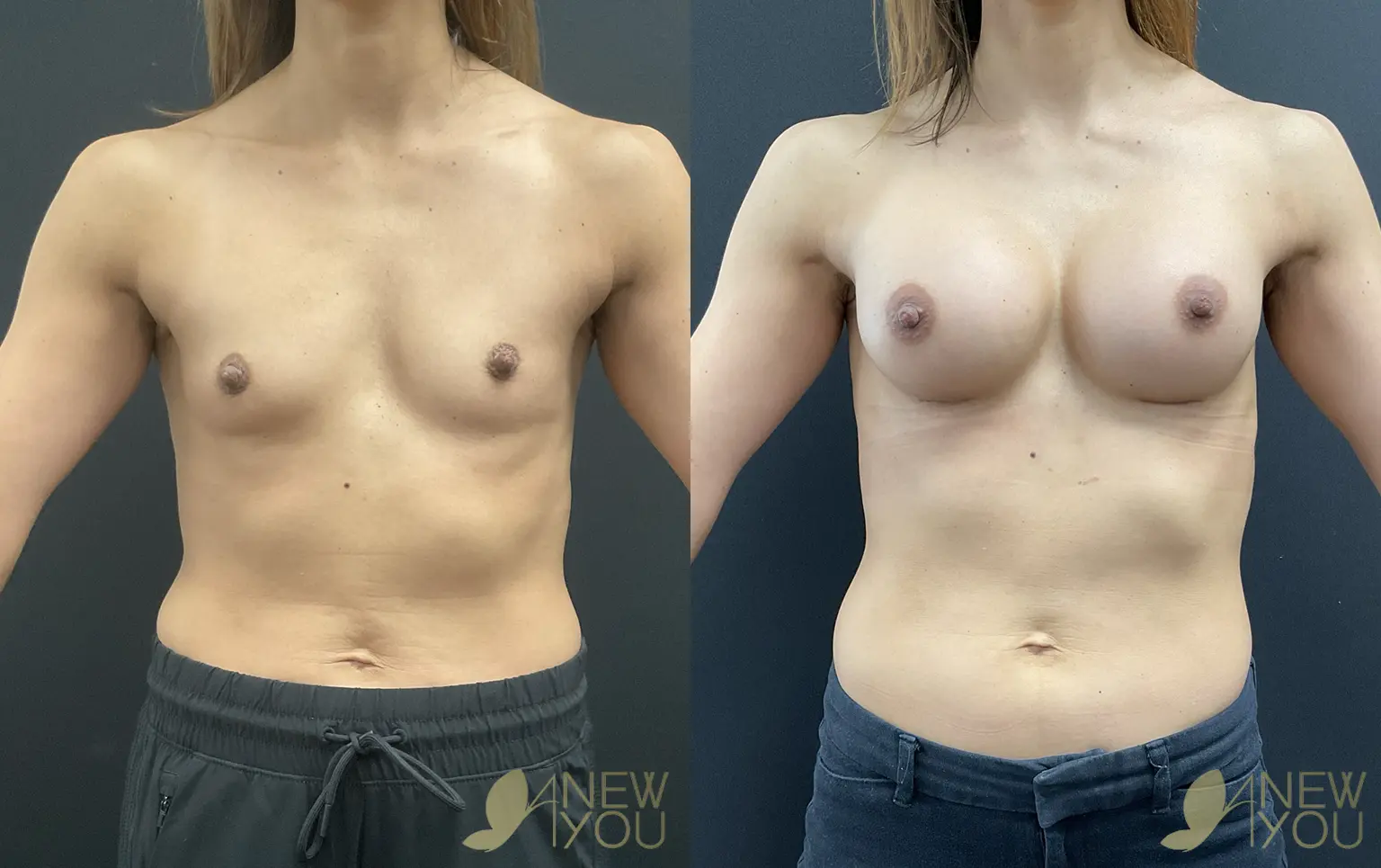 breast-aug-AD-02