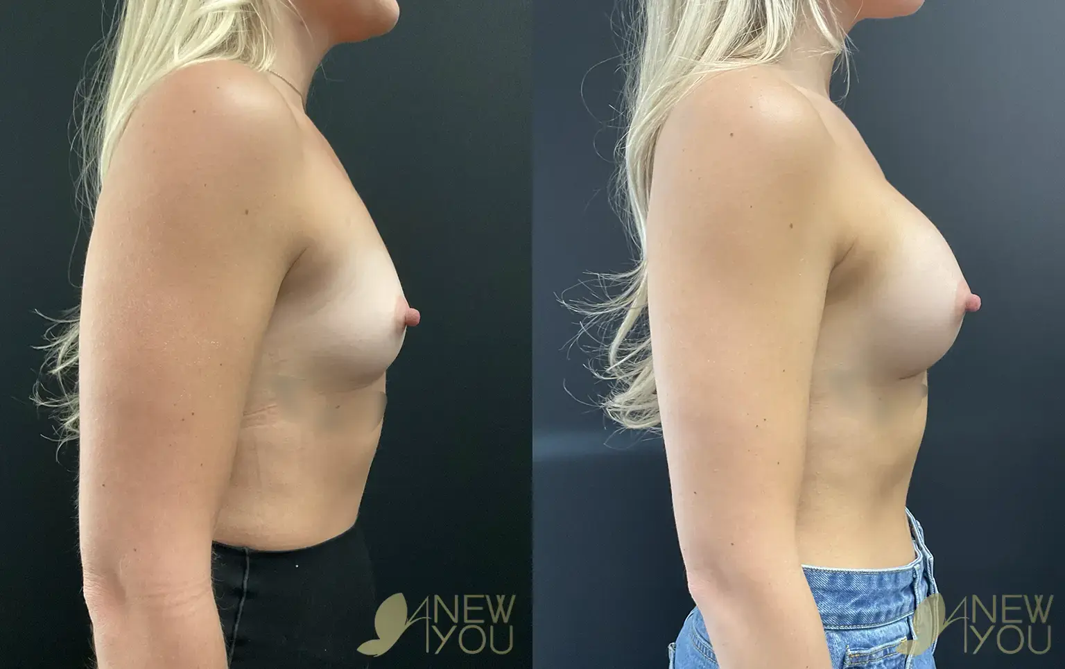 breast-aug-SA-03