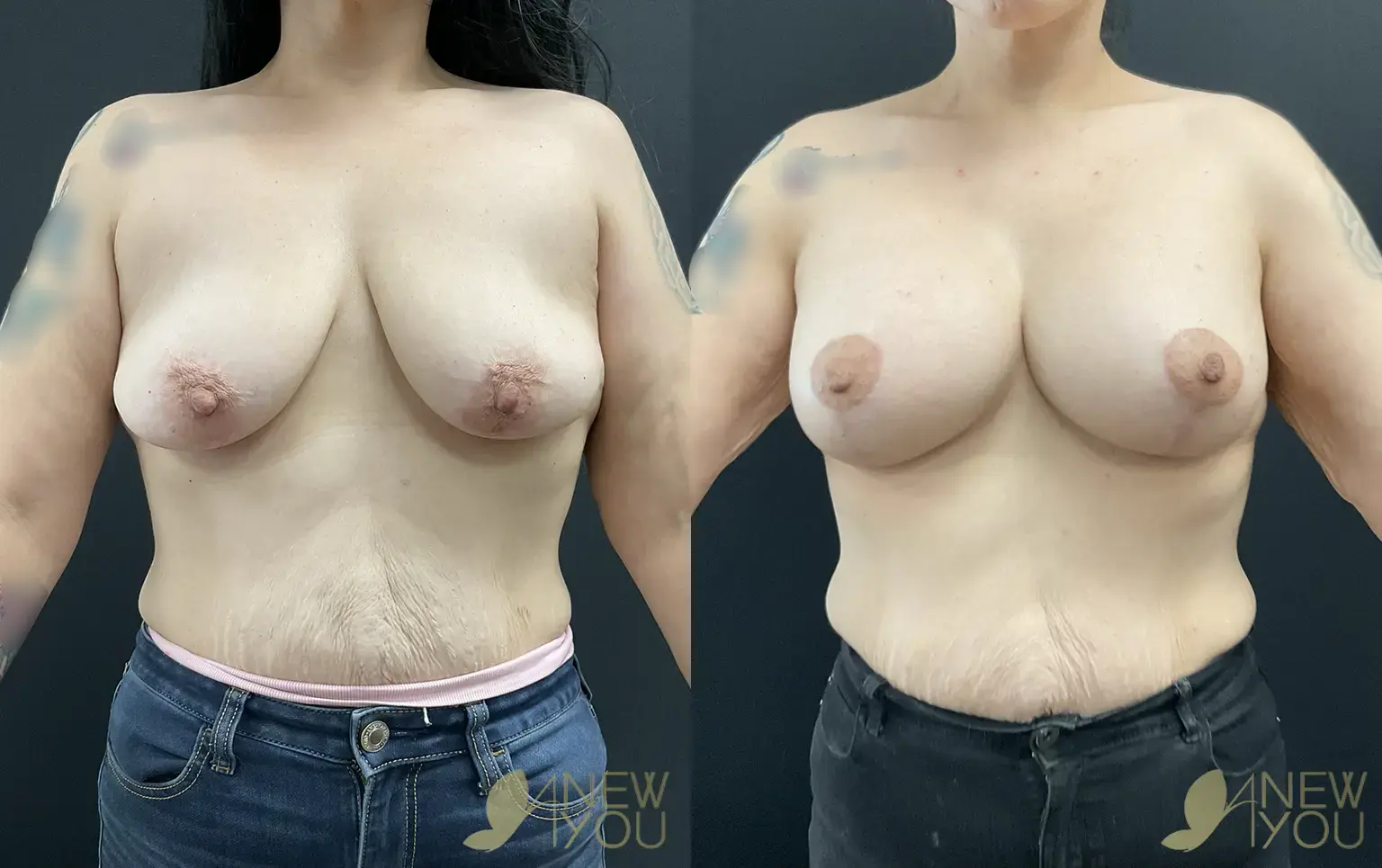 breast-lift-aug-RH-01