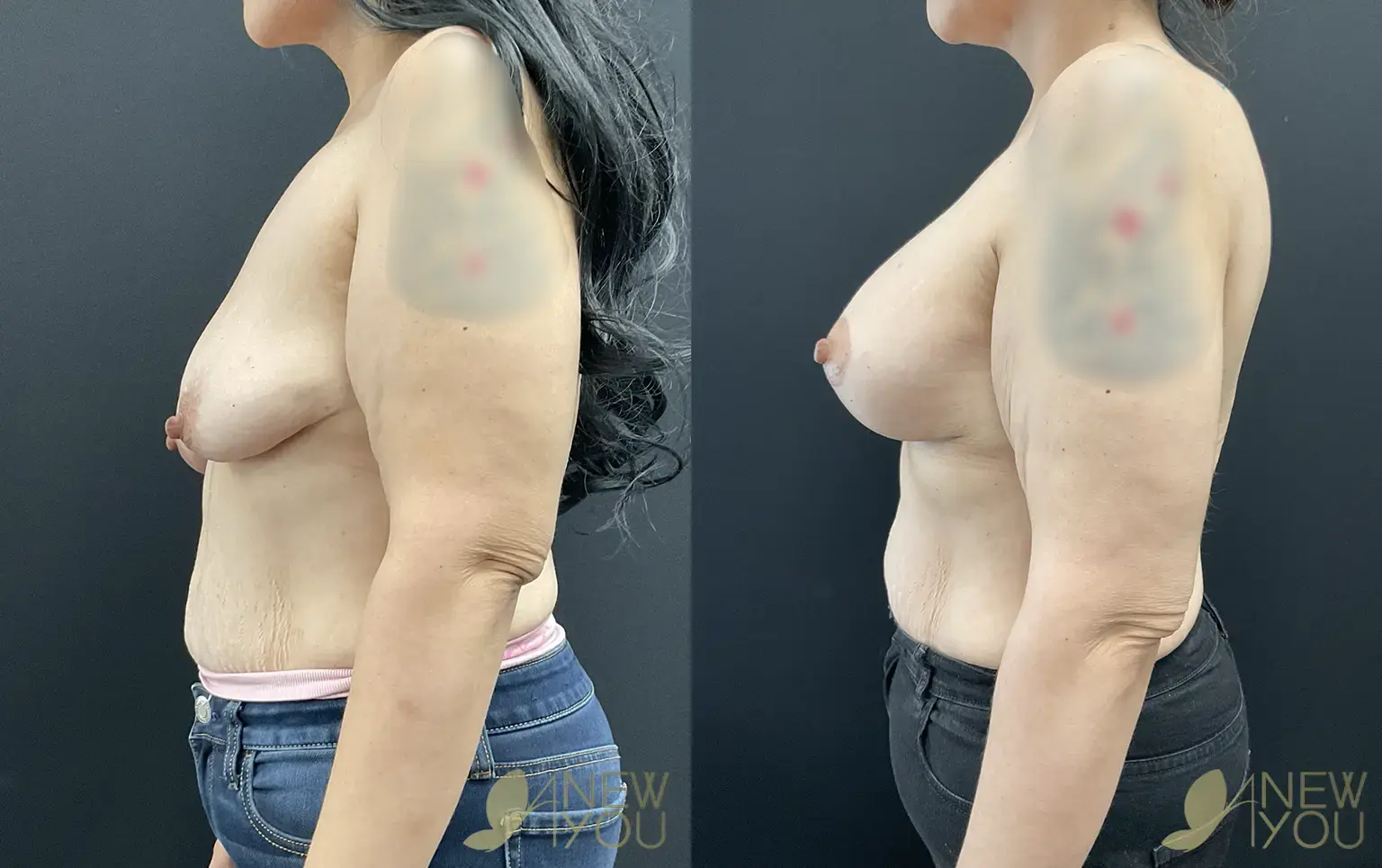 breast-lift-aug-RH-02