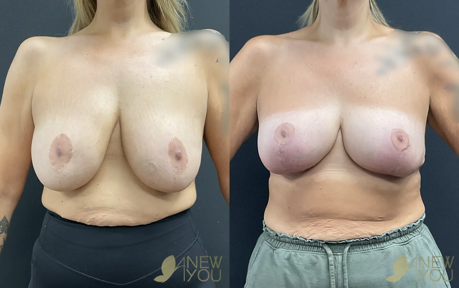 breast-lift-aug-TS-01