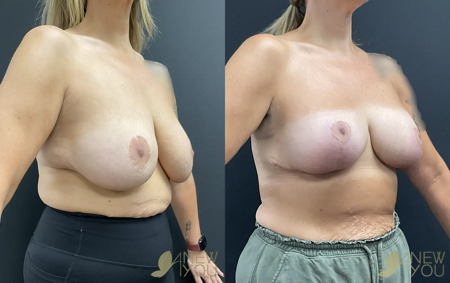 breast-lift-aug-TS-02