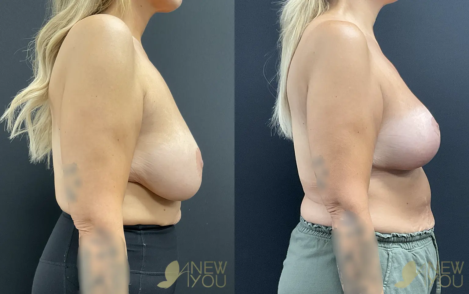 breast-lift-aug-TS-03