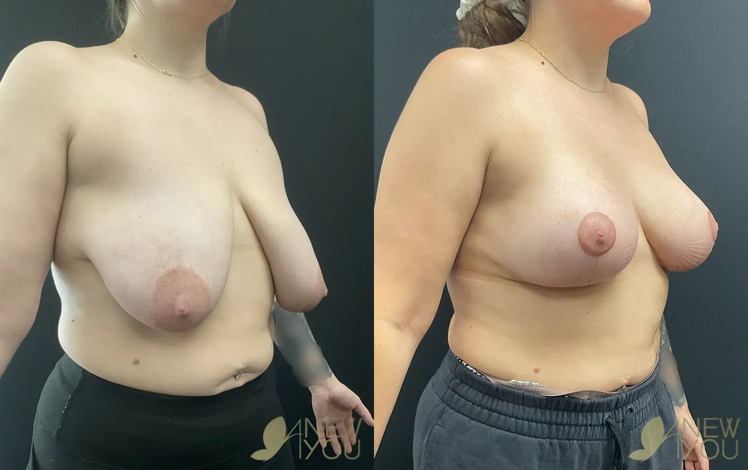 breast-lift-aug-VE-02