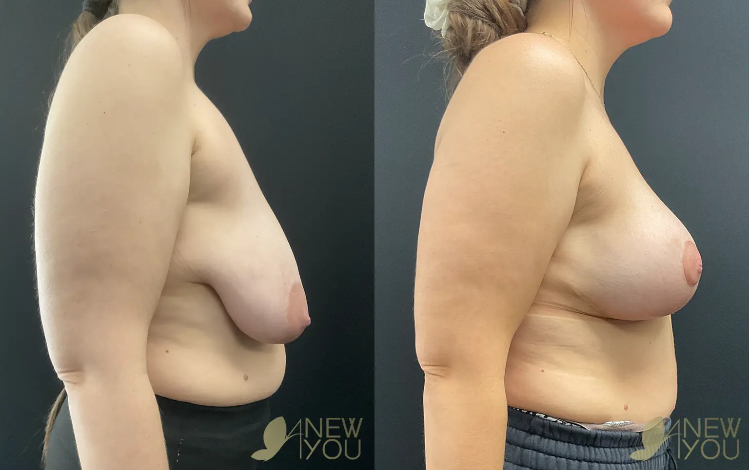 breast-lift-aug-VE-03