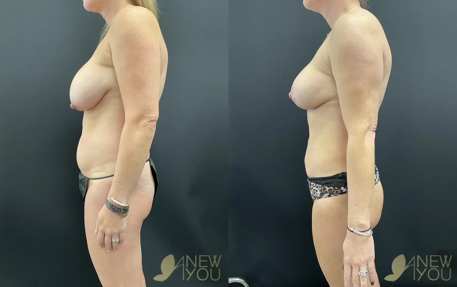 breast-lift-mommy-SS-02