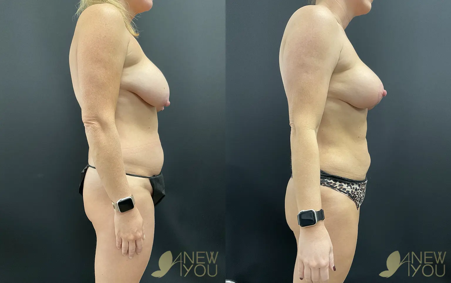 breast-lift-mommy-SS-03