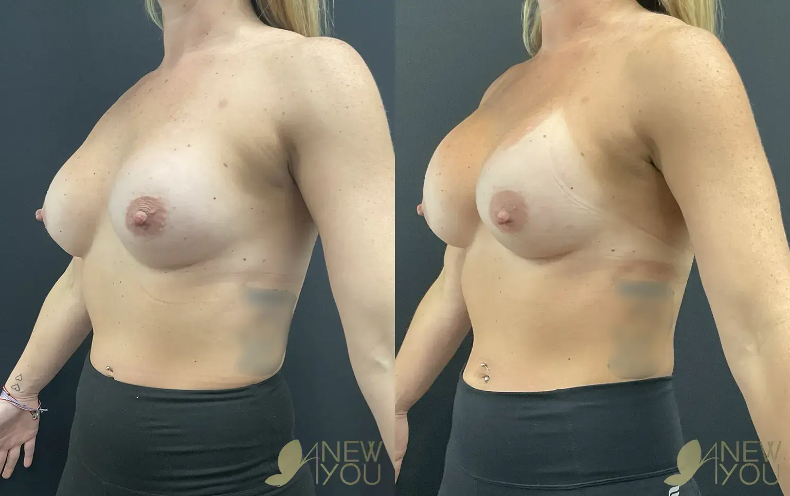 breast-rev-JB-03