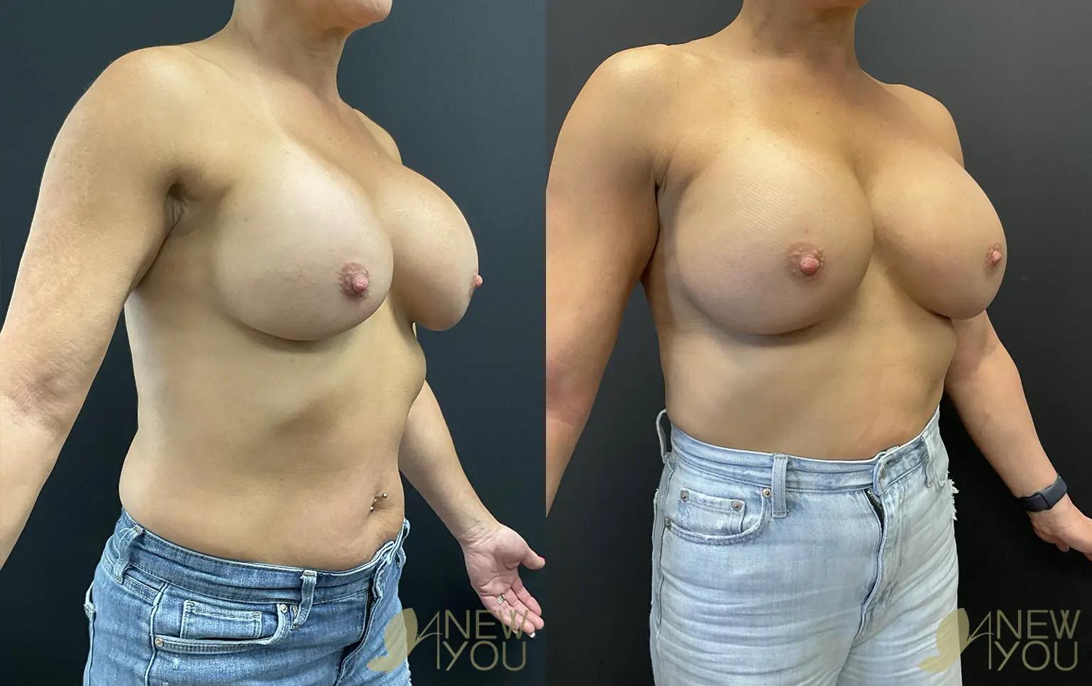 breast-revision-PB-02