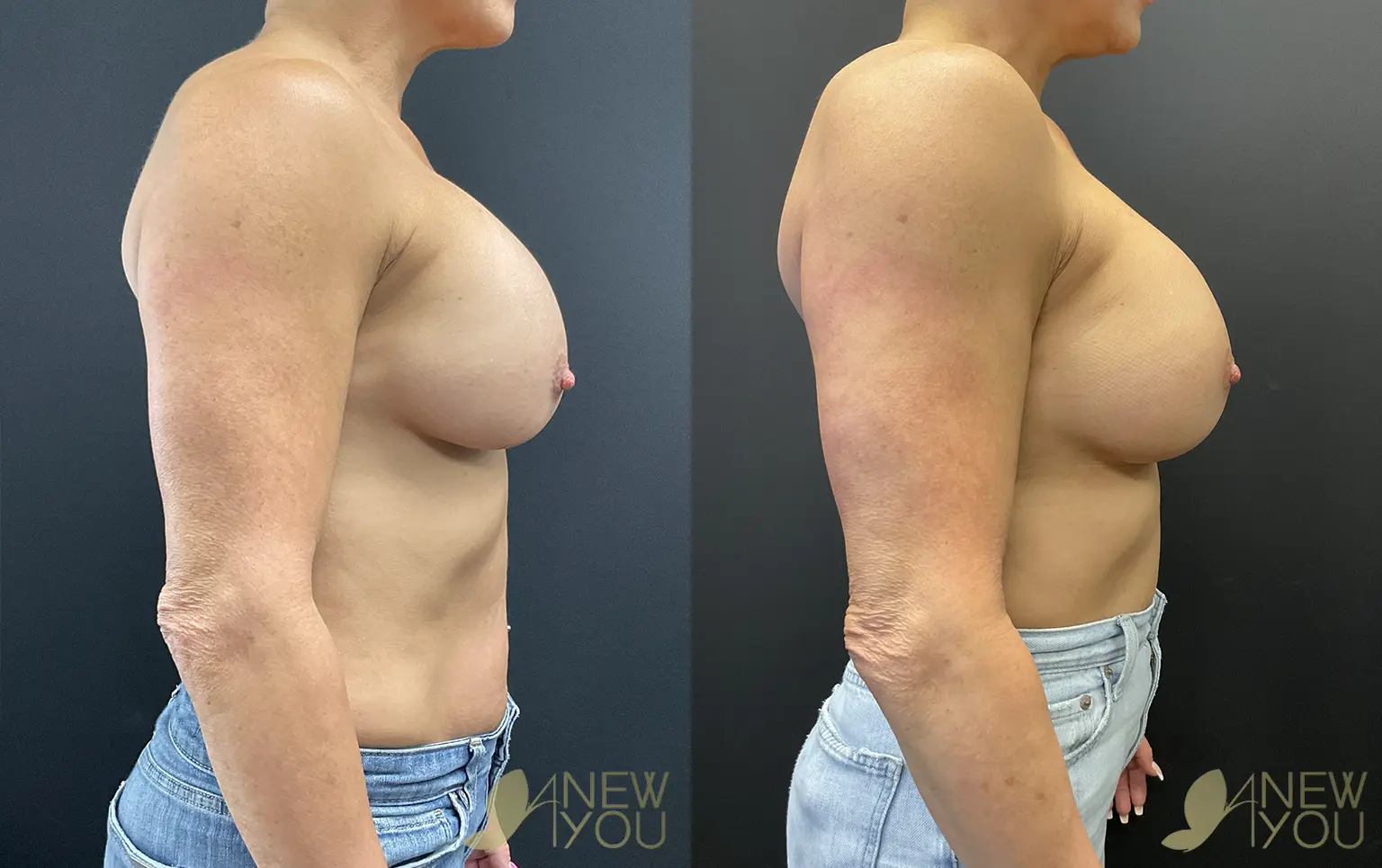 breast-revision-PB-03