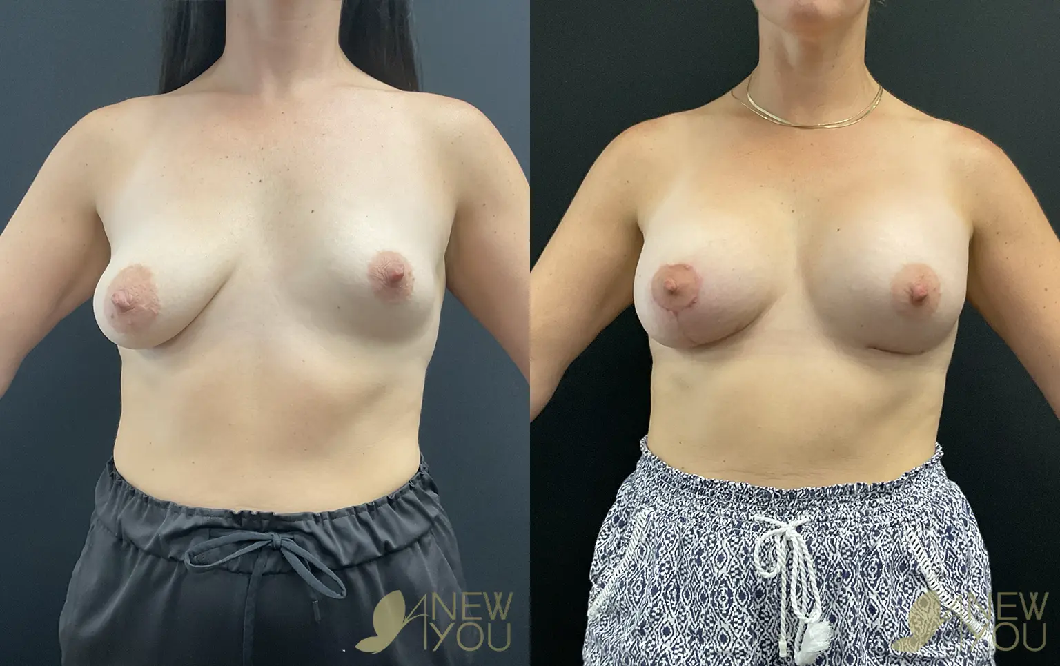 mastopexy-aug-BM-01