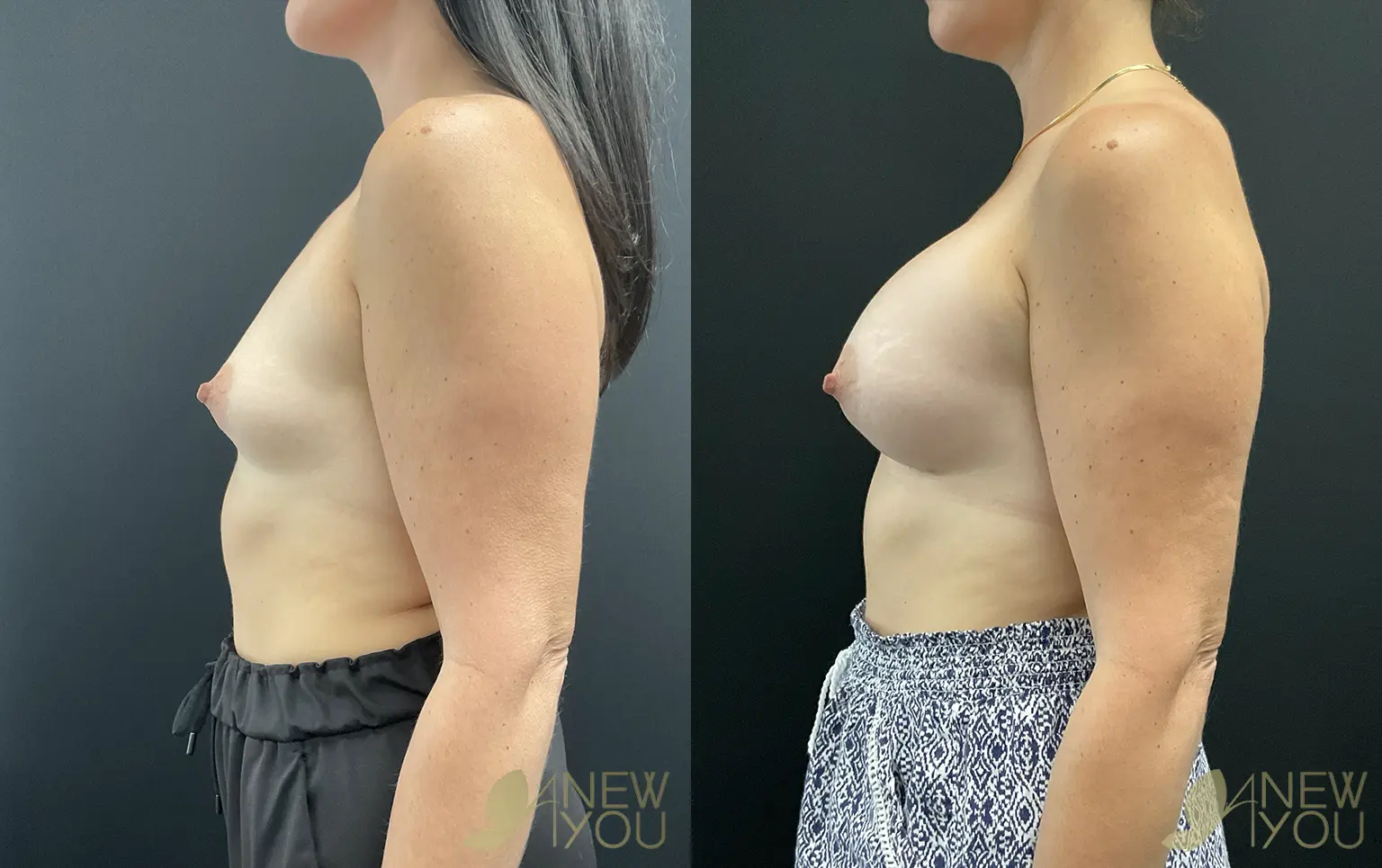 mastopexy-aug-BM-02
