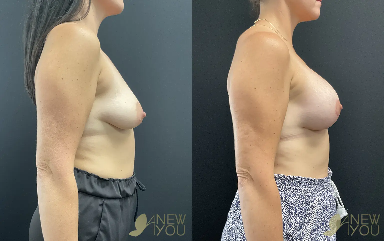 mastopexy-aug-BM-03
