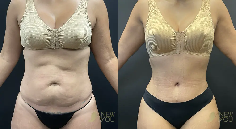 tummy-tuck-p01-01-VB-C