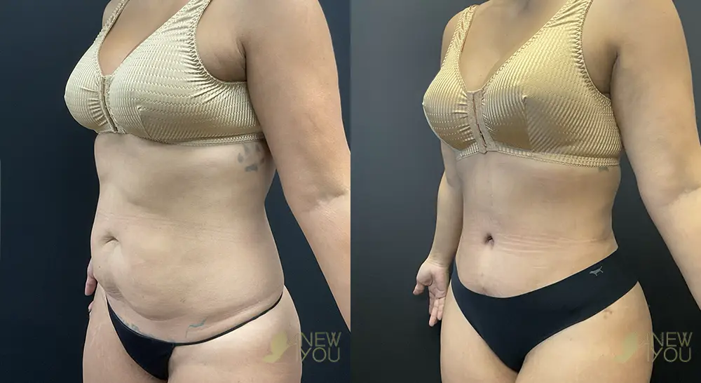 tummy-tuck-p01-02-VB-C
