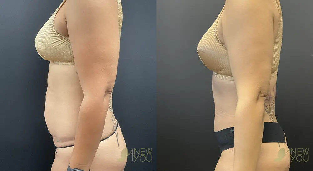 tummy-tuck-p01-03-VB-C